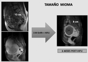 Tratamiento de mioma de 13 cm utilizando 3 meses de análogos de Gn-Rh previos al tratamiento con ultrasonidos de alta intensidad (HIFU). Ablación completa. 